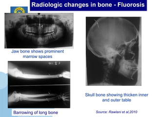 Radiologic changes in bone - Fluorosis




Jaw bone shows prominent
     marrow spaces




                           Skull bone showing thicken inner
                                    and outer table

    www.ancollege.org
Barrowing of long bone          Source: Rawlani et al,2010
 