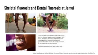 Skeletal ﬂuorosis and Dental Fluorosis at Jamui
https://medium.com/@ﬂuorideindia/why-does-bihars-ﬂuorosis-problem-needs-urgent-attention-fba3f68ccf56
 
