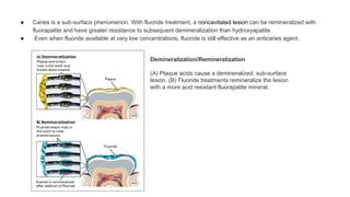 ● Caries is a sub-surface phenomenon. With fluoride treatment, a noncavitated lesion can be remineralized with
fluorapatite and have greater resistance to subsequent demineralization than hydroxyapatite.
● Even when fluoride available at very low concentrations, fluoride is still effective as an anticaries agent.
Demineralization/Remineralization
(A) Plaque acids cause a demineralized, sub-surface
lesion. (B) Fluoride treatments remineralize the lesion
with a more acid resistant fluorapatite mineral.
 