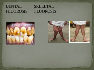 DENTAL SKELETAL
FLUOROSIS FLUOROSIS
 