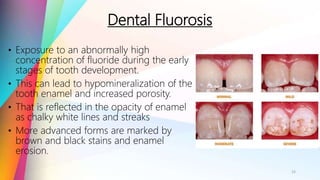 Dental Fluorosis
• Exposure to an abnormally high
concentration of fluoride during the early
stages of tooth development.
• This can lead to hypomineralization of the
tooth enamel and increased porosity.
• That is reflected in the opacity of enamel
as chalky white lines and streaks
• More advanced forms are marked by
brown and black stains and enamel
erosion.
15
 
