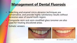 • Bleaching and enamel micro abrasion techniques are
conservative, and provide highly satisfactory results without
excessive wear of sound tooth region.
• Composite resin and resin-modified glass ionomer are also
used for treating discolored areas.
• Esthetic veneers
Management of Dental Fluorosis
 