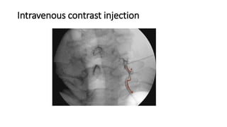 Direct Inject Contrast Fluoroscopy ,Radiation safety and contrast agents including adverse ...