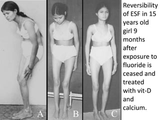 Reversibility
of ESF in 15
years old
girl 9
months
after
exposure to
fluoride is
ceased and
treated
with vit-D
and
calcium.
 