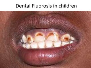 Dental Fluorosis in children
 