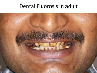 Dental Fluorosis in adult
 