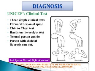 ◦
◦
◦
◦
◦
◦

Three simple clinical tests
Forward flexion of spine
Chin to Chest test
Hands on the occiput test
Normal person can do
Person with skeletal
fluorosis can not.

Left figures Normal, Right Abnormal
SWAMI VIVEKANANDA INSTITUTE OF PHARMACEUTICAL
SCIENCES(SVIPS), VANGAPALLY, BHONGIR

 