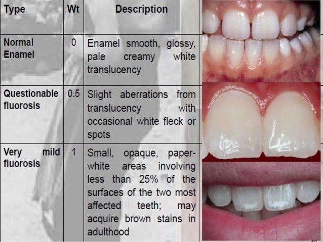 Natural Treatment For Fluorosis Natural Treatment For Fluorosis
