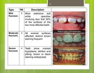 Type Wt Description
2
Mild
fluorosis
More extensive dull
white opacities
involving less that 50%
of the surfaces of the
two most affected teeth.
Moderate 3
fluorosis
All enamel surfaces
affected; distinct brown
staining frequent
4
Severe
fluorosis
Teeth show marked
hypoplasia, attrition and
pitting; brown or black
staining widespread.
Kuldeep Vyas M.Sc. CHN
19
 