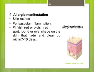 4. Allergic manifestation
• Skin rashes
• Perivascular inflammation.
• Pinkish red or bluish red
spot, round or oval shape on the
skin that fade and clear up
within7-10 days.
Kuldeep Vyas M.Sc. CHN
29
 