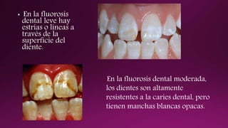 • En la fluorosis
dental leve hay
estrías o líneas a
través de la
superficie del
diente.
En la fluorosis dental moderada,
los dientes son altamente
resistentes a la caries dental, pero
tienen manchas blancas opacas.
 