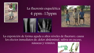 La fluorosis esquelética
4 ppm-15ppm
La exposición de forma aguda a altos niveles de fluoruro, causa
los efectos inmediatos de: dolor abdominal, saliva en exceso,
náuseas y vómitos.
 