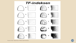 Fluorosis Index- Department of Public Health Dentistry 23
 