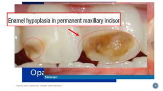 Fluorosis Index- Department of Public Health Dentistry 7
 