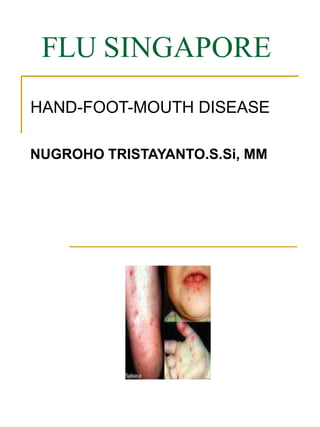 FLU SINGAPORE
HAND-FOOT-MOUTH DISEASE
NUGROHO TRISTAYANTO.S.Si, MM
 