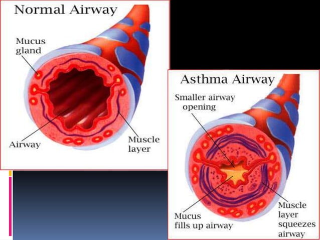 Flutter a device for clearance of airway | PPTX | Physical Therapy ...