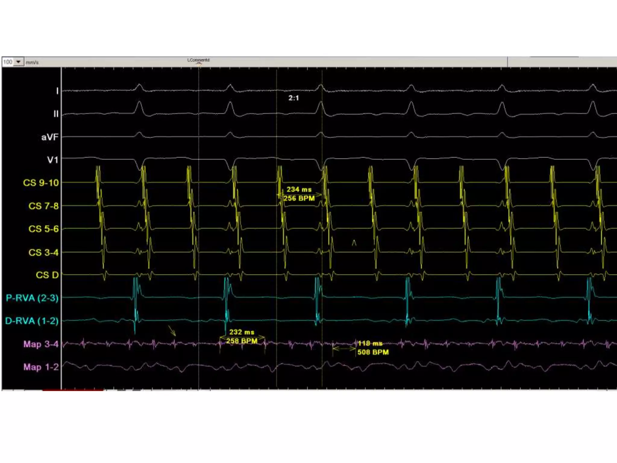 Flutter Ablation 2018 PPT