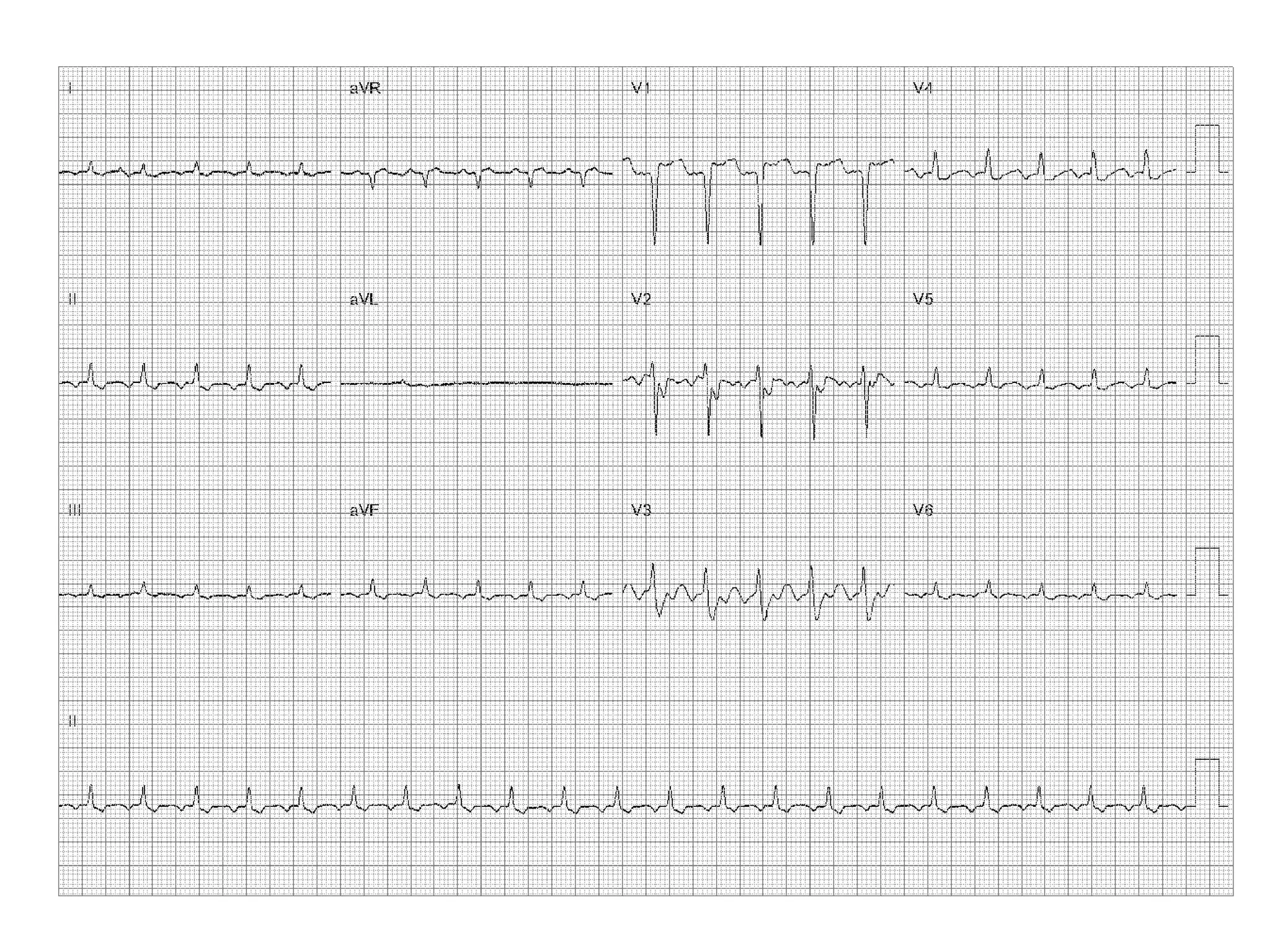 Flutter Ablation 2018 PPT