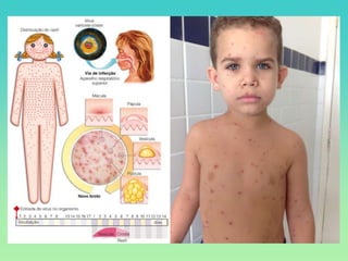 Fluxograma para diagnóstico das doenças exantemáticas na infância - Prof. Robson Slide 77