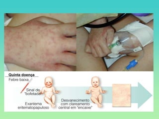 Fluxograma para diagnóstico das doenças exantemáticas na infância - Prof. Robson Slide 8