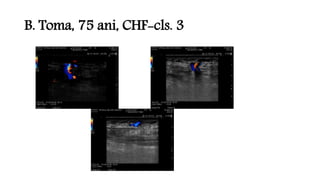 B. Toma, 75 ani, CHF-cls. 3
 