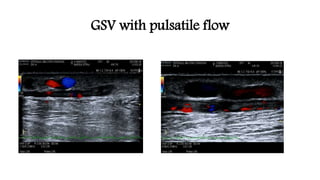 GSV with pulsatile flow
 