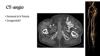 CT-angio
• Femoral A-V fistula
• Congenital?
 
