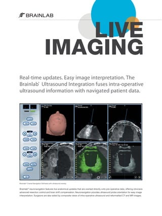 LIVE
IMAGING
Real-time updates. Easy image interpretation. The
Brainlab® Ultrasound Integration fuses intra-operative
ultrasound information with navigated patient data.

Brainlab ® Cranial Navigation Software with ultrasound overlay

Brainlab® neuronavigation features live anatomical updates that are overlaid directly onto pre-operative data, offering clinicians
advanced resection control and brain shift compensation. Neuronavigation provides ultrasound probe orientation for easy image
interpretation. Surgeons are also aided by composite views of intra-operative ultrasound and reformatted CT and MR images.

 