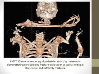Pmct Volume Rendering Imaging techniques in forensic medicine | PDF