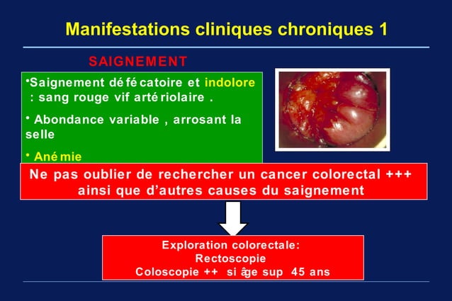 Fmc maladie hemorroidaire Pr Arbaoui fac med tlemcen