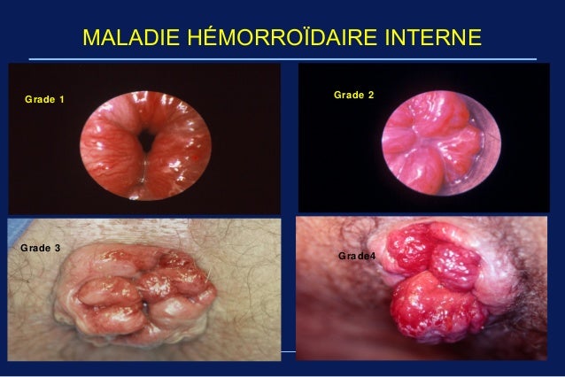 Fmc maladie hemorroidaire Pr Arbaoui fac med tlemcen Fmc maladie hemorroidaire Pr Arbaoui fac med tlemcen