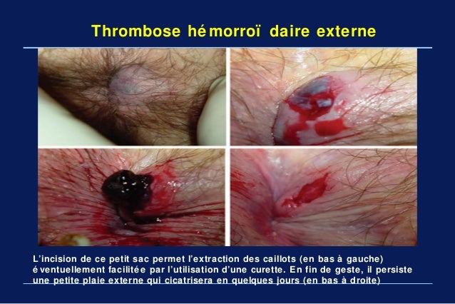 Fmc maladie hemorroidaire Pr Arbaoui fac med tlemcen Fmc maladie hemorroidaire Pr Arbaoui fac med tlemcen