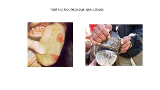 FOOT AND MOUTH DISEASE- ORAL LESIONS
 