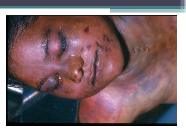 Asphyxia From FME by Dr Yaseen Mohammad for 3rd year MBBS