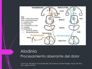 Alodinia
Procesamiento aberrante del dolor
Clauw DJ, Arnold LM, McCarberg BH. The Science of Fibromyalgia. Mayo Clin Proc.
2011; 86(9): 907-9011
 