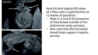 Fetal Intestinal Rotation FM fetal GI system development, embryology and ultrasound features.pptx