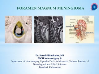 cka
Dr. Suresh Bishokama, MS
MCH Neurosurgery ®
Department of Neurosurgery, Upendra Devkota Memorial National Institute of
Neurological and Allied Sciences
Bansbari, Kathmandu
FORAMEN MAGNUM MENINGIOMA
 