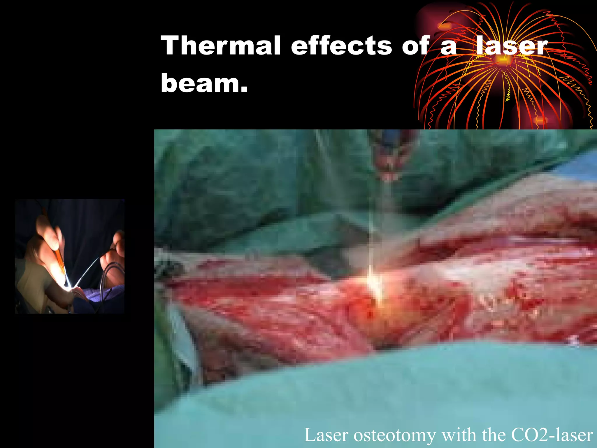 Thermal effects of a  laser  beam. Laser osteotomy with the CO2-laser   