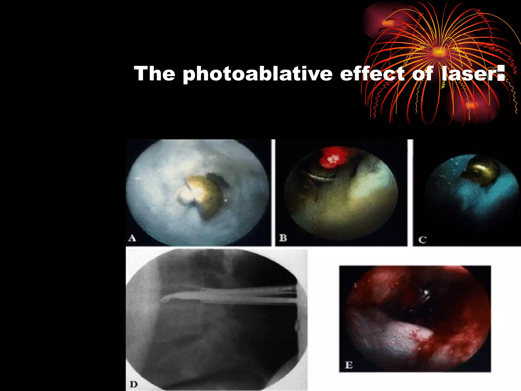   The photoablative effect of laser : 