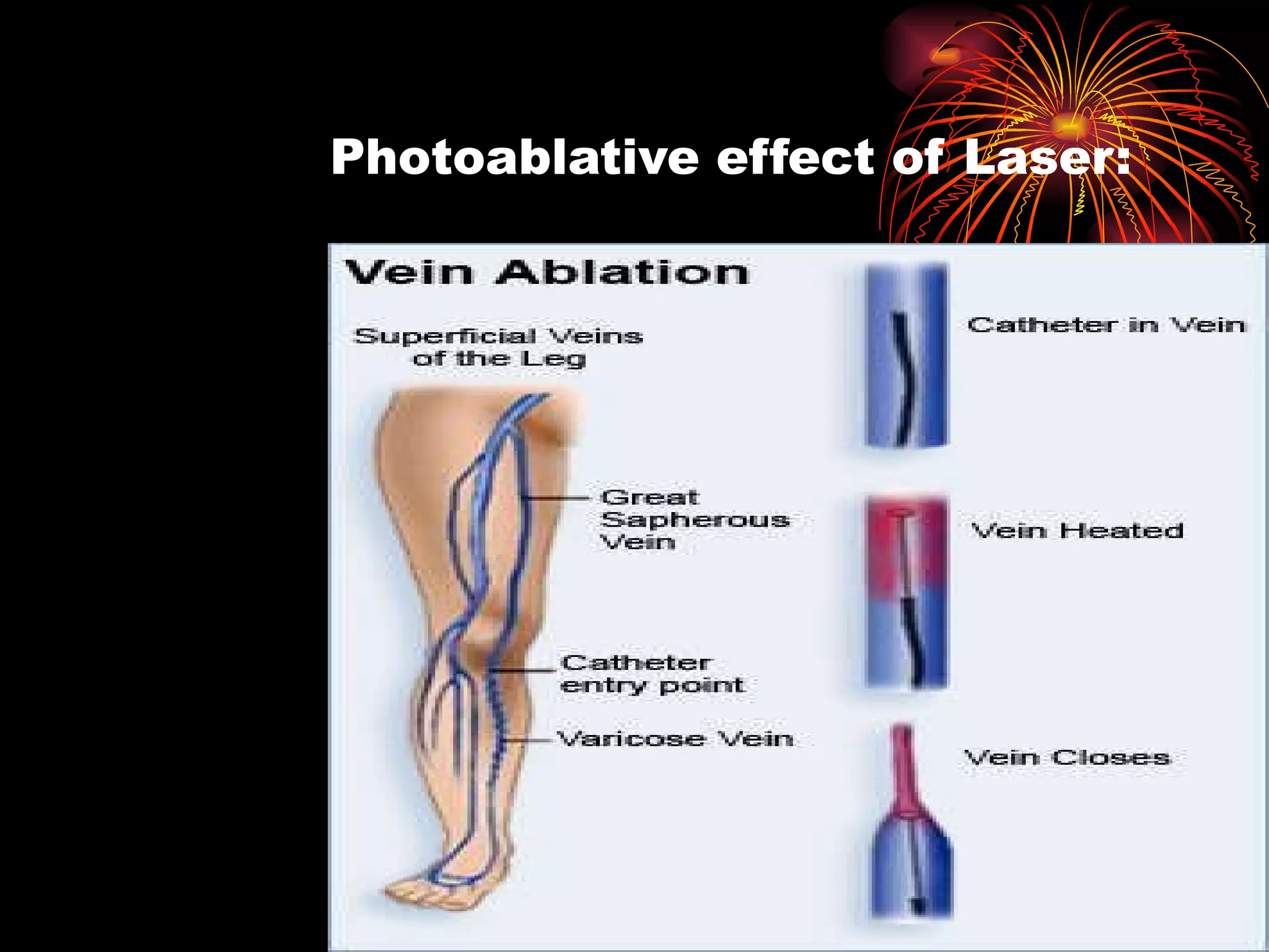 Photoablative effect of Laser: 
