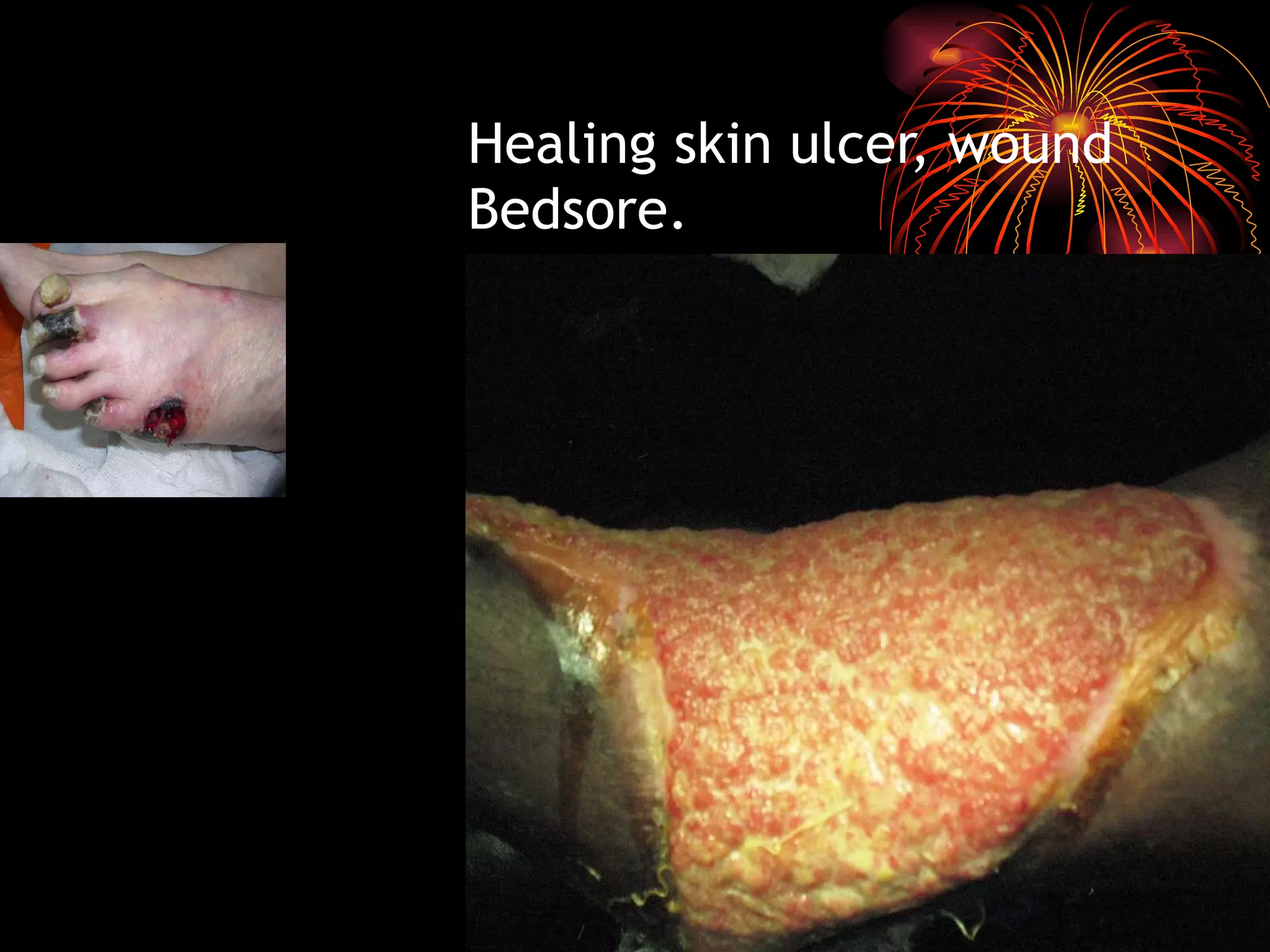 Healing skin ulcer, wound Bedsore. 