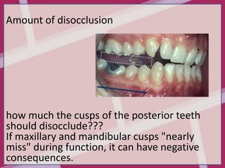 Tooth Disocclude full mouth rehabilitation ppt including all | PPTX