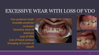 Full mouth rehabilitation in prosthodontics | PPTX