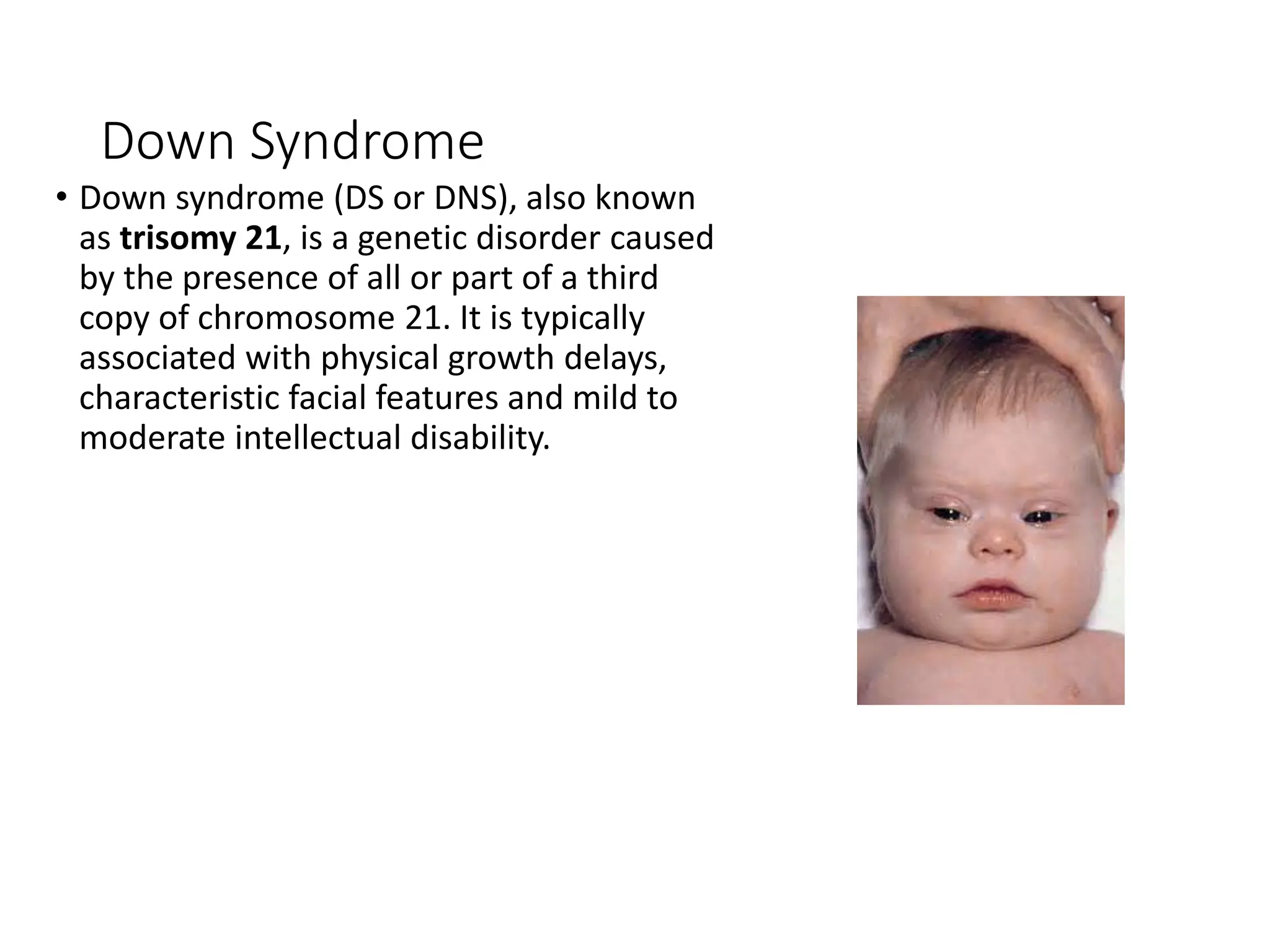 Down Syndrome
• Down syndrome (DS or DNS), also known
as trisomy 21, is a genetic disorder caused
by the presence of all or part of a third
copy of chromosome 21. It is typically
associated with physical growth delays,
characteristic facial features and mild to
moderate intellectual disability.
 