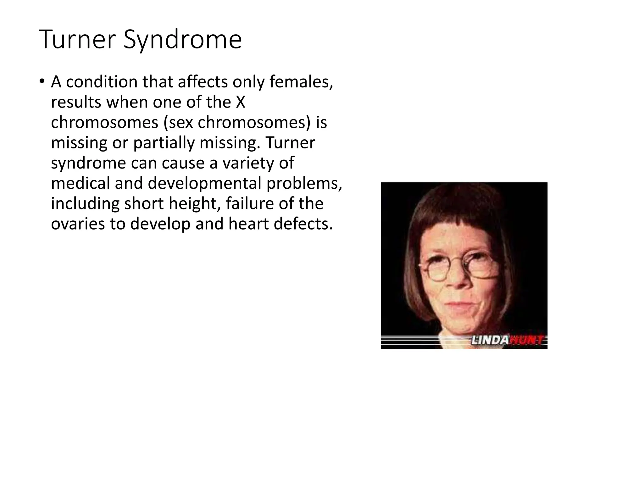 Turner Syndrome
• A condition that affects only females,
results when one of the X
chromosomes (sex chromosomes) is
missing or partially missing. Turner
syndrome can cause a variety of
medical and developmental problems,
including short height, failure of the
ovaries to develop and heart defects.
 