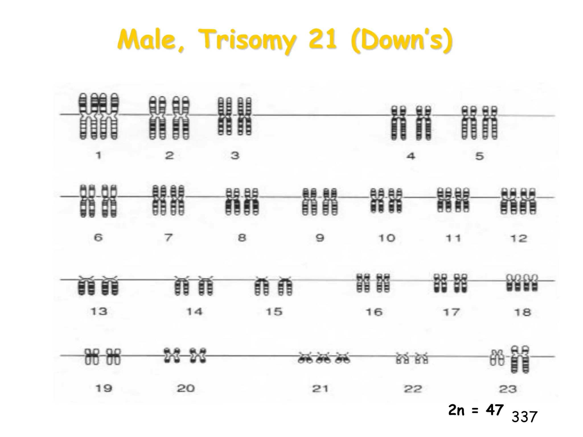 Male, Trisomy 21 (Down’s)
337
2n = 47
 