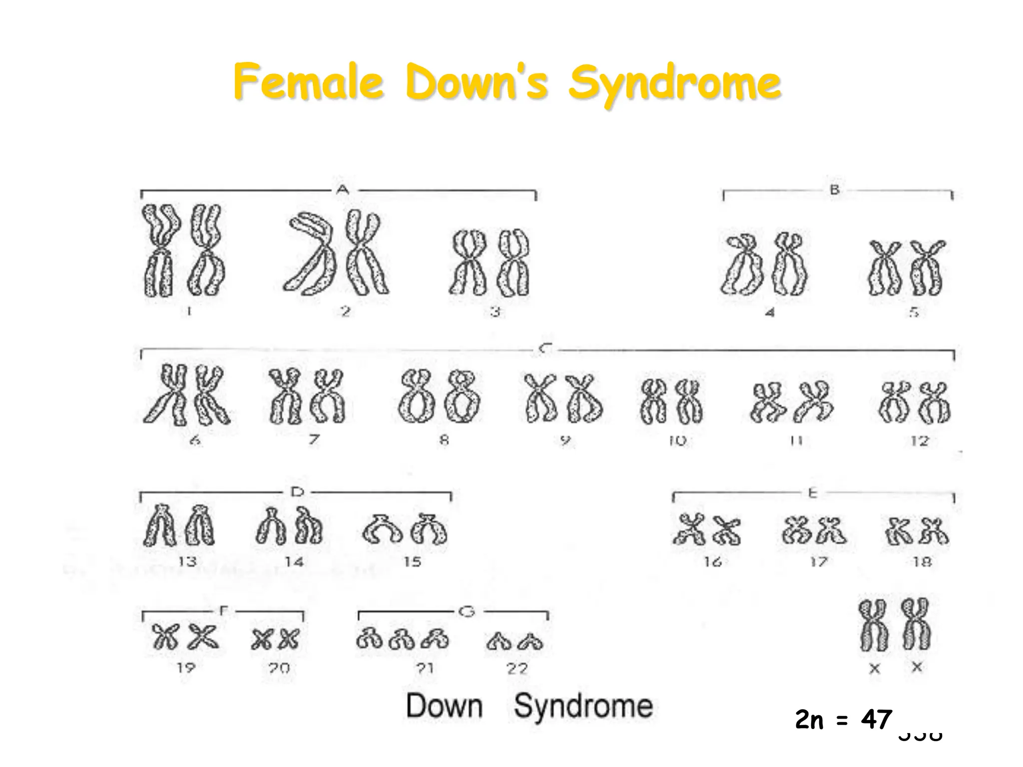 Female Down’s Syndrome
338
2n = 47
 