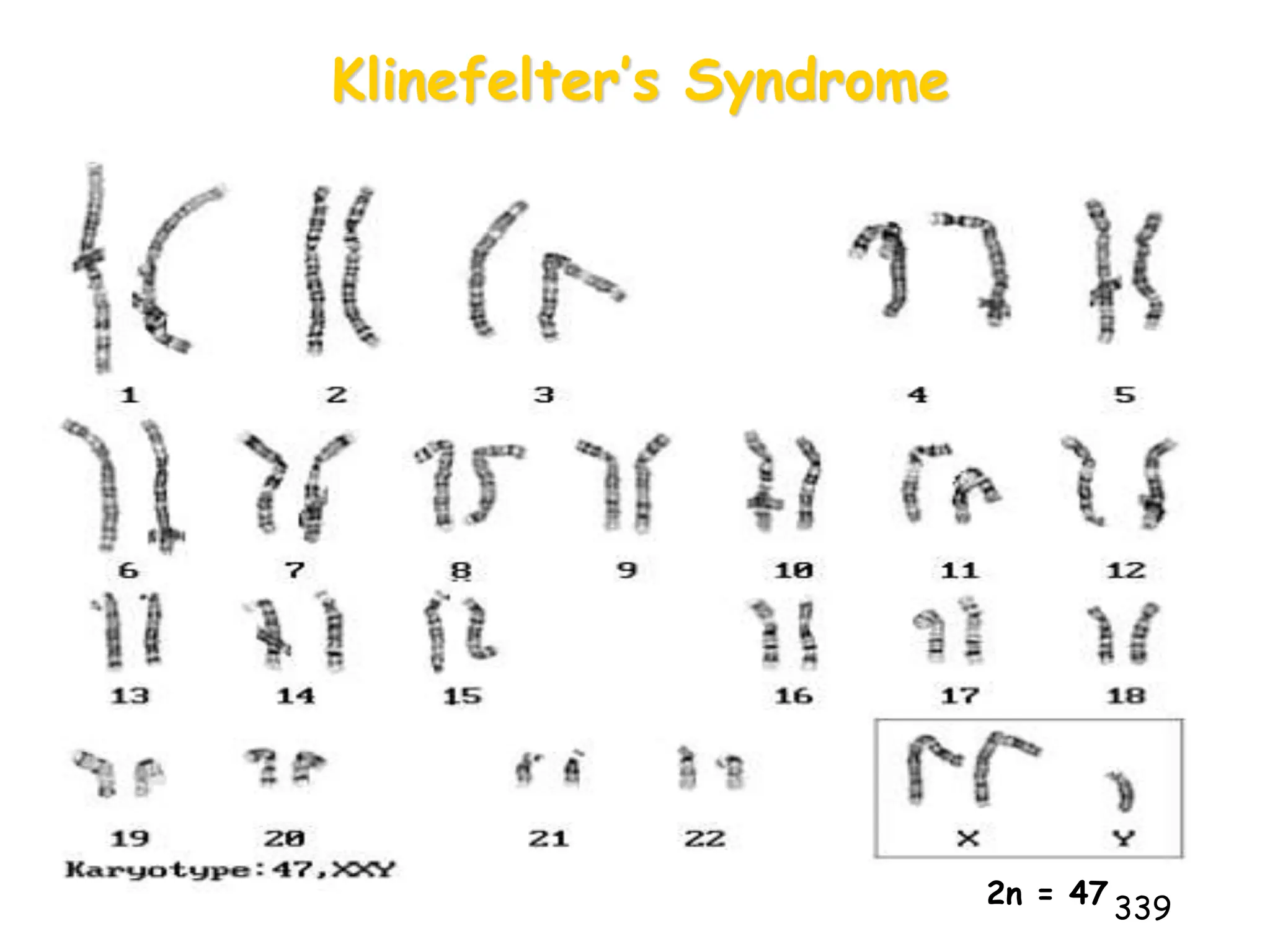 Klinefelter’s Syndrome
339
2n = 47
 