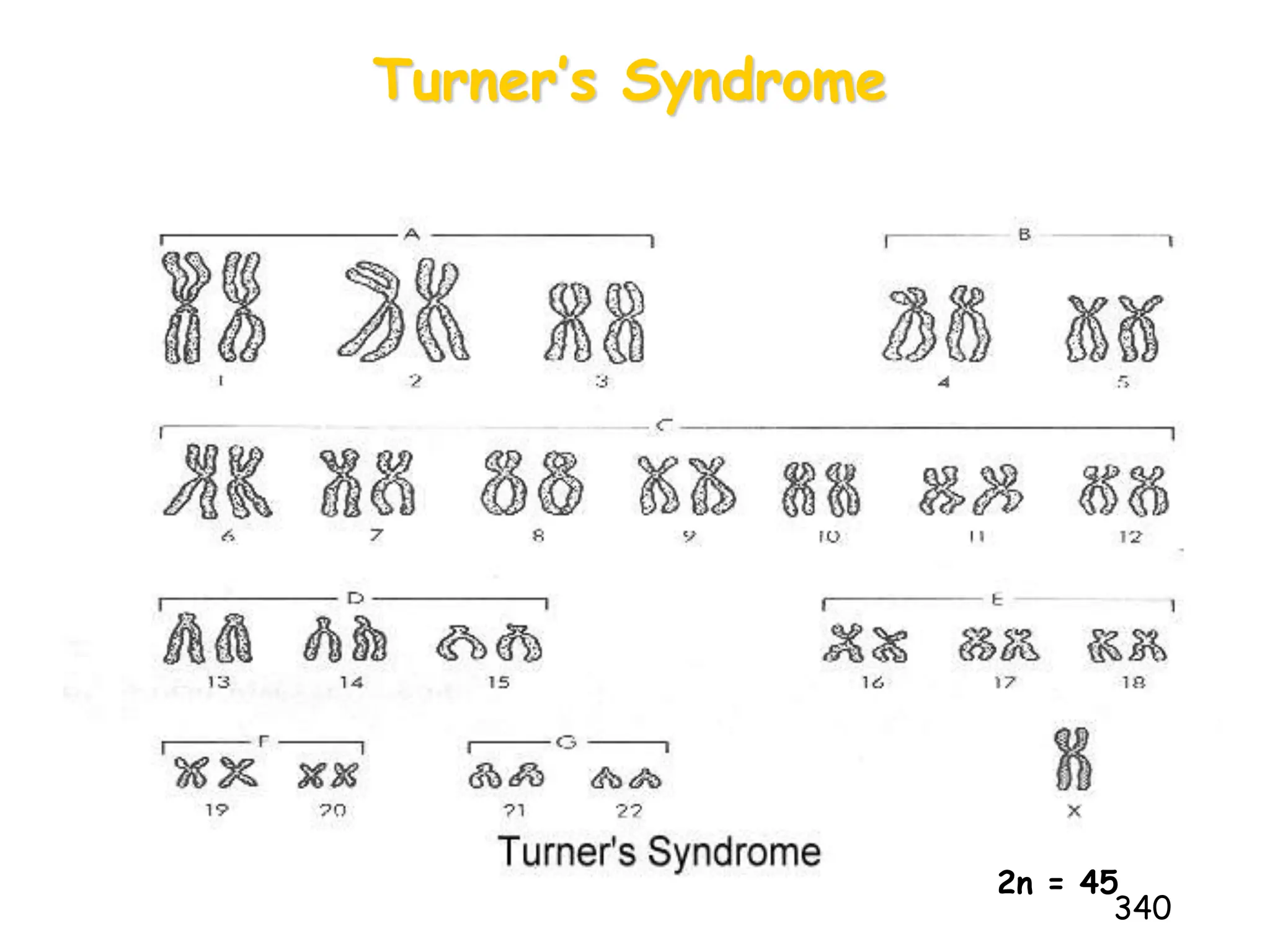 Turner’s Syndrome
340
2n = 45
 