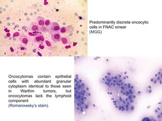 Predominantly discrete oncocytic
cells in FNAC smear
(MGG)
Oncocytomas contain epithelial
cells with abundant granular
cytoplasm identical to those seen
in Warthin tumors, but
oncocytomas lack the lymphoid
component
(Romanowsky’s stain).
 